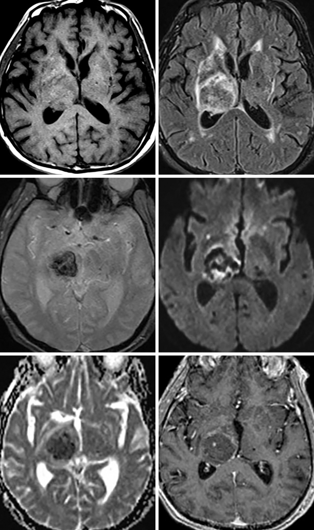 Cerebral Hemorrhage | The Neurosurgical Atlas, by Aaron Cohen-Gadol, M.D.