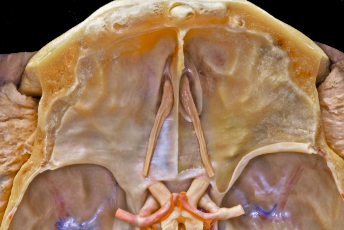 Anterior Cranial Fossa Endocranial Perspective | Neuroanatomy | The ...