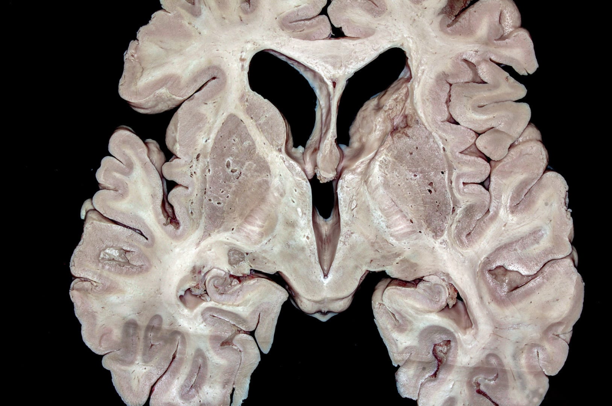 Axial Section of the Brain at the Level of the Foramina of Monro ...