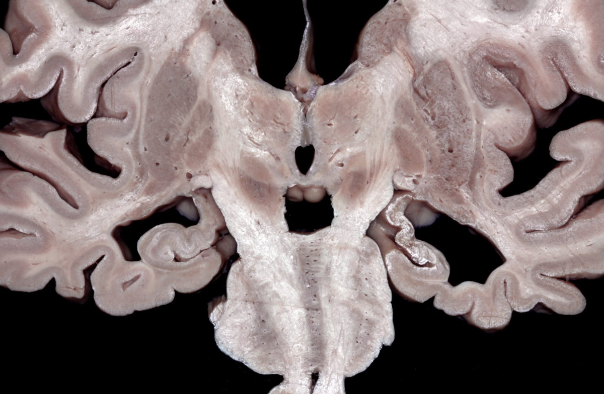 Coronal Section Through the Thalamus and Subthalamus | Neuroanatomy ...