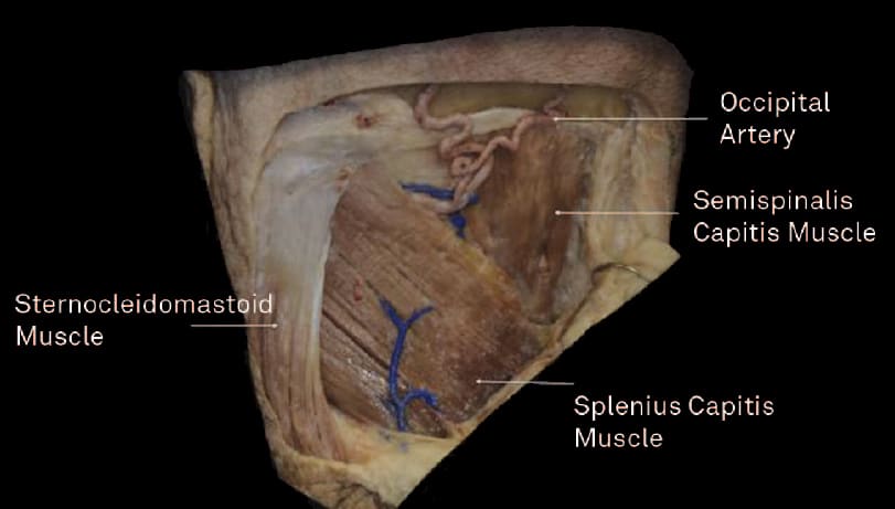 Detachment of the Trapezius and Sternocleidomastoid Muscles ...