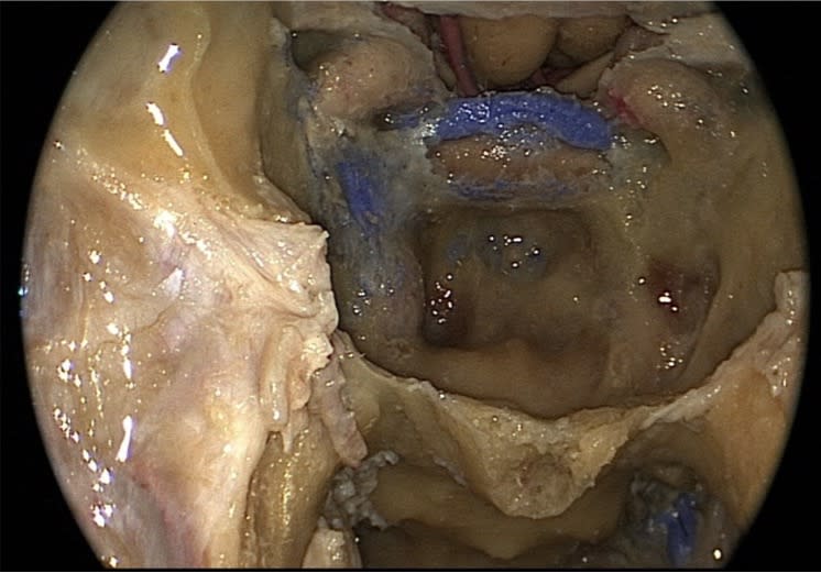 Endoscopic Transpterygoid Transmaxillary Approach | Neuroanatomy | The ...