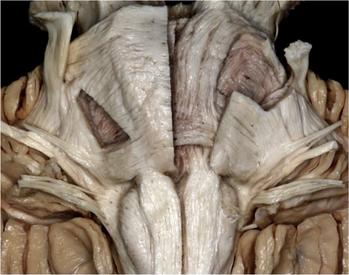 Fiber Dissection of the Ventral Pons and Medulla | Neuroanatomy | The ...