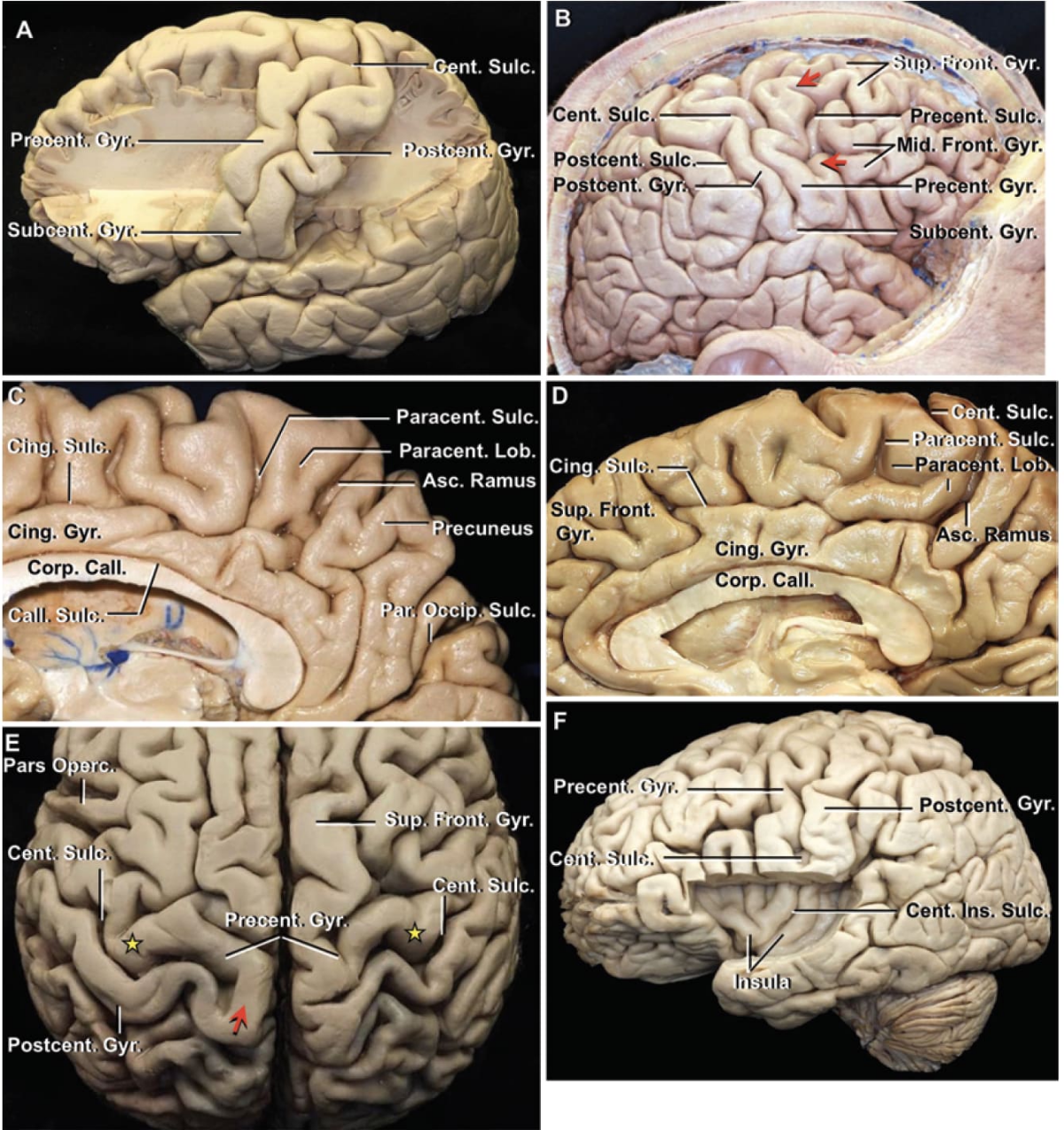 Gyral and Sulcal Patterns in Multiple Hemispheres | Neuroanatomy | The ...