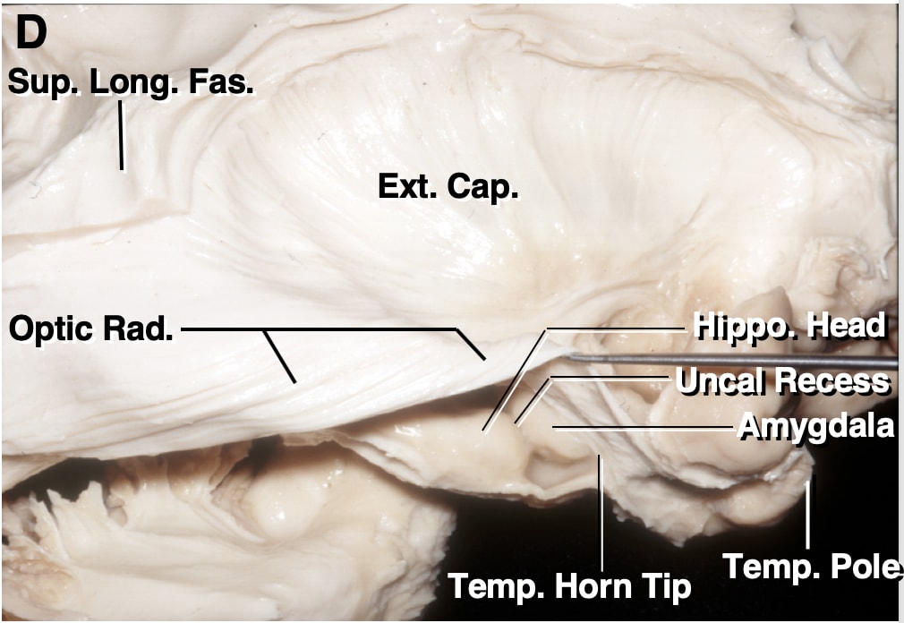 Hippocampal Head and Temporal Pole Anatomy | Neuroanatomy | The ...