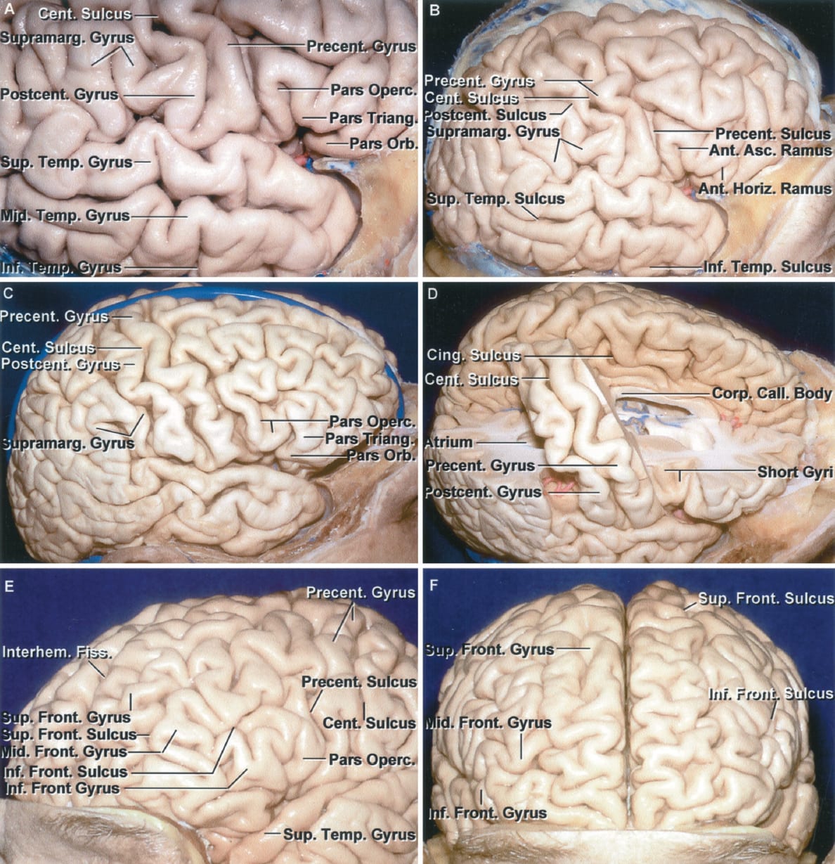 Identification of the Pre- and Postcentral Gyri and Variations in the ...