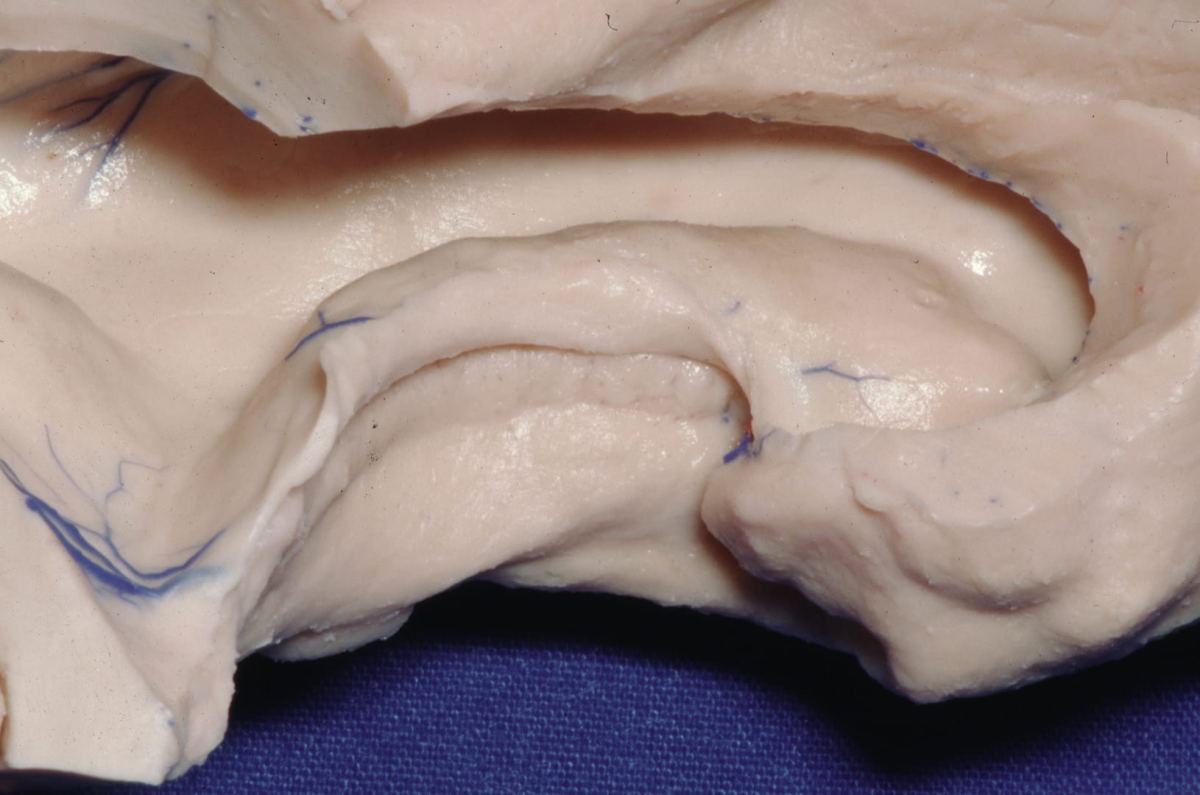 Left Temporal Lobe (Superior View) | Neuroanatomy | The Neurosurgical Atlas