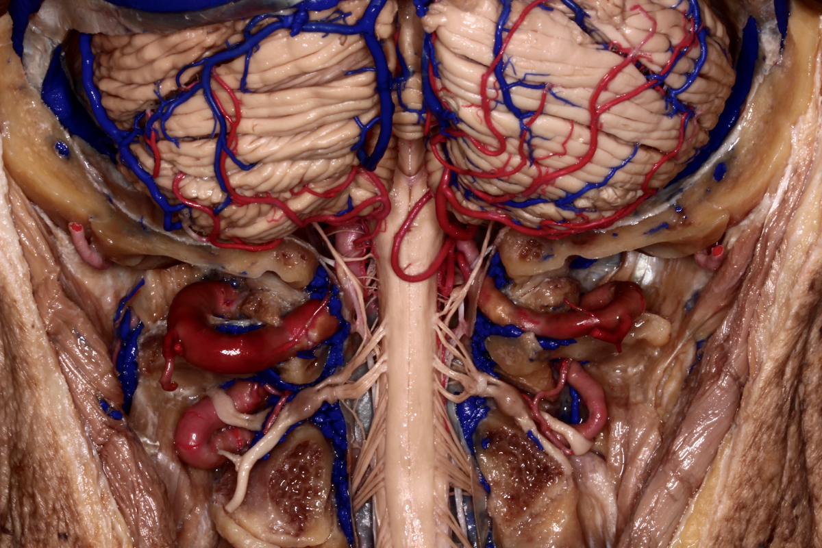 Posterior Coronal View of Dissection Through the Posterior Cranial ...