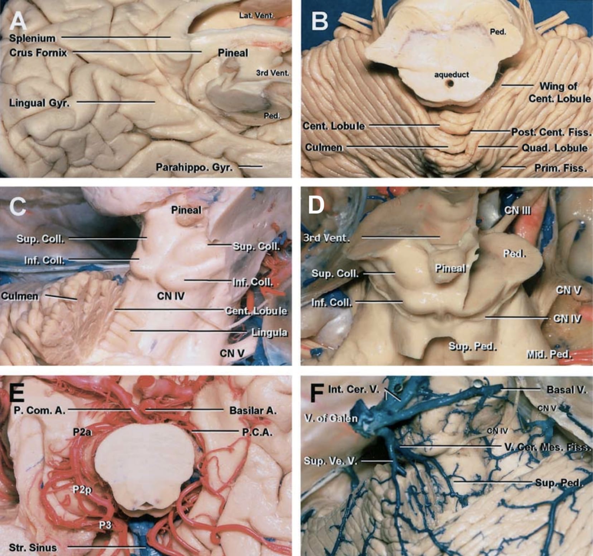 Posterior Incisural Space with Anatomical Relationships | Neuroanatomy ...