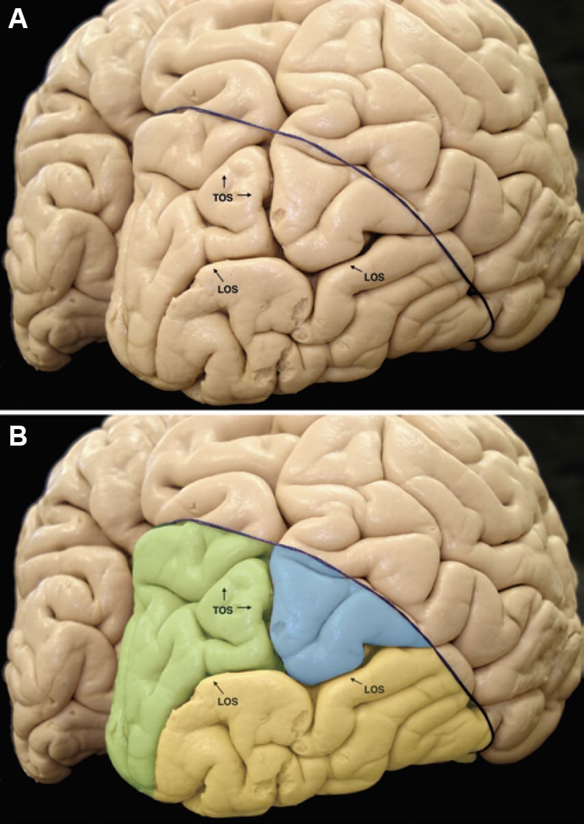 Posterolateral View of the Right Hemisphere | Neuroanatomy | The ...