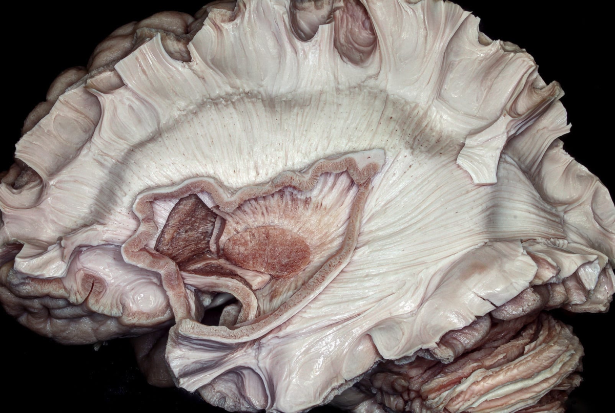 Sagittal View of the Corona Radiata, Internal Capsule and Basal Ganglia ...