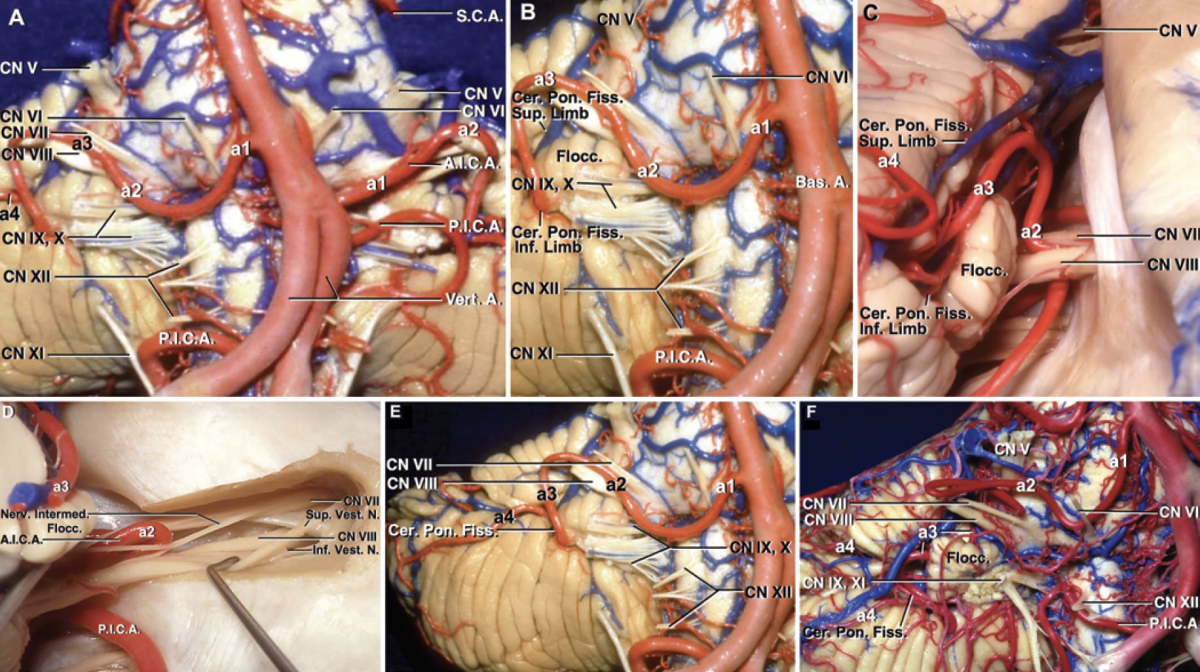 Segments of the AICA | Neuroanatomy | The Neurosurgical Atlas