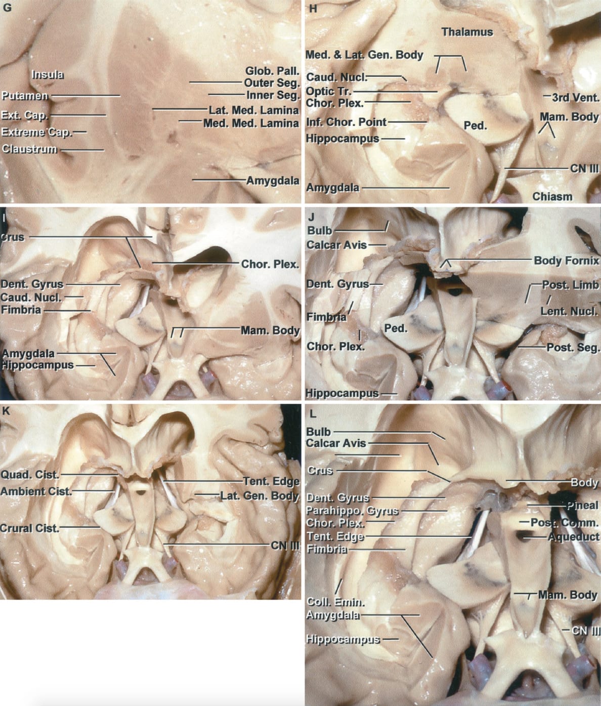 Stepwise Dissection of the Cerebral Hemispheres, Beginning Anteriorly G ...