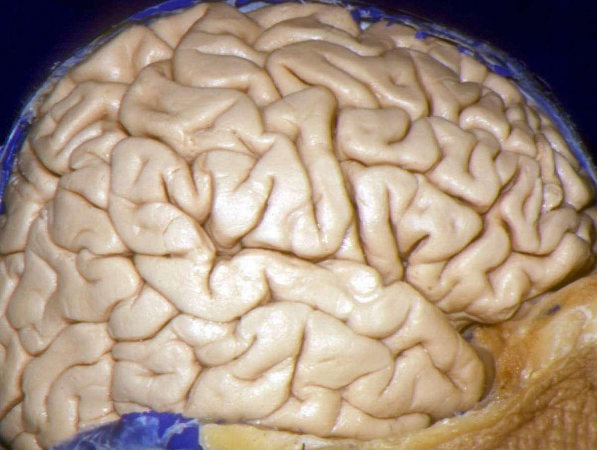 Superolateral View of the Right Cerebral Hemisphere | Neuroanatomy ...
