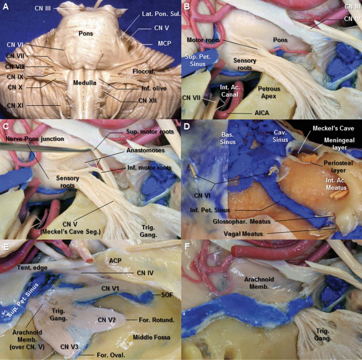Trigeminal Ganglion and Regional Anatomy | Neuroanatomy | The ...