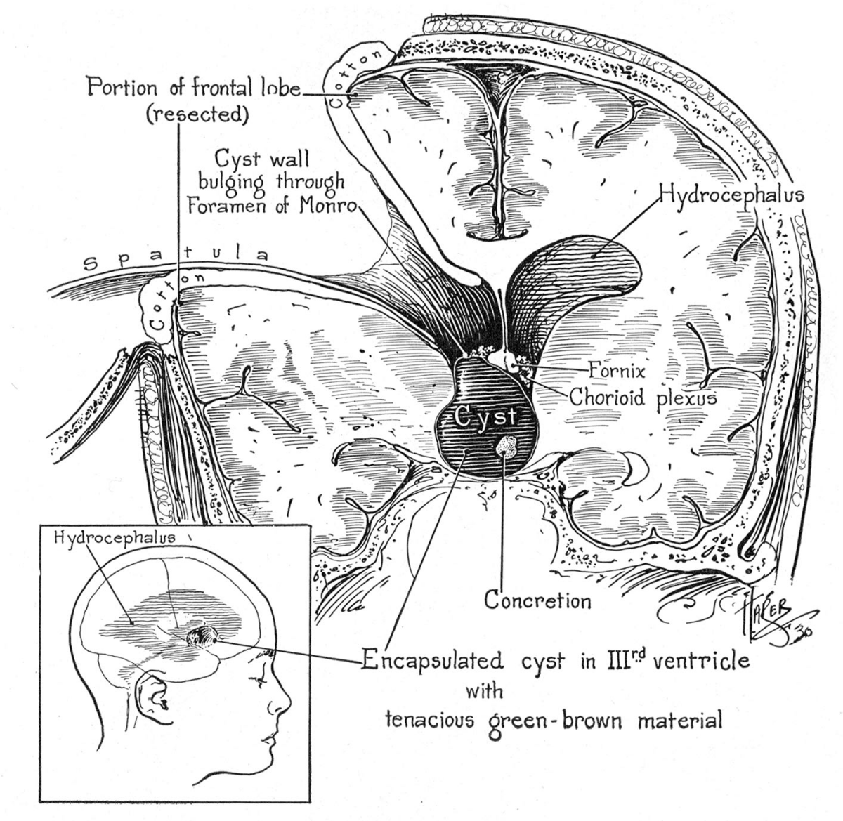 Transcallosal Expanded Transforaminal Transvenous Transchoroidal Route ...