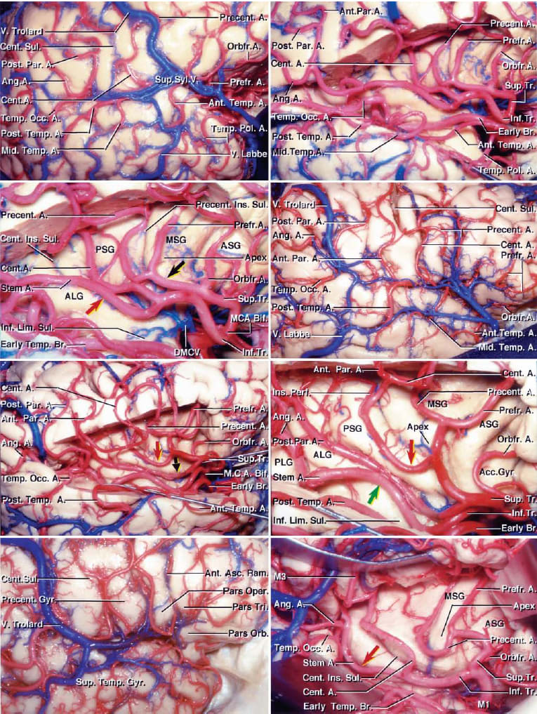Temporal AVMs | Cohen Collection | Volumes | The Neurosurgical Atlas