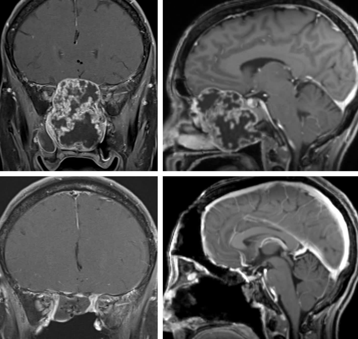 Bifrontal Craniotomy | Cohen Collection | Volumes | The Neurosurgical Atlas