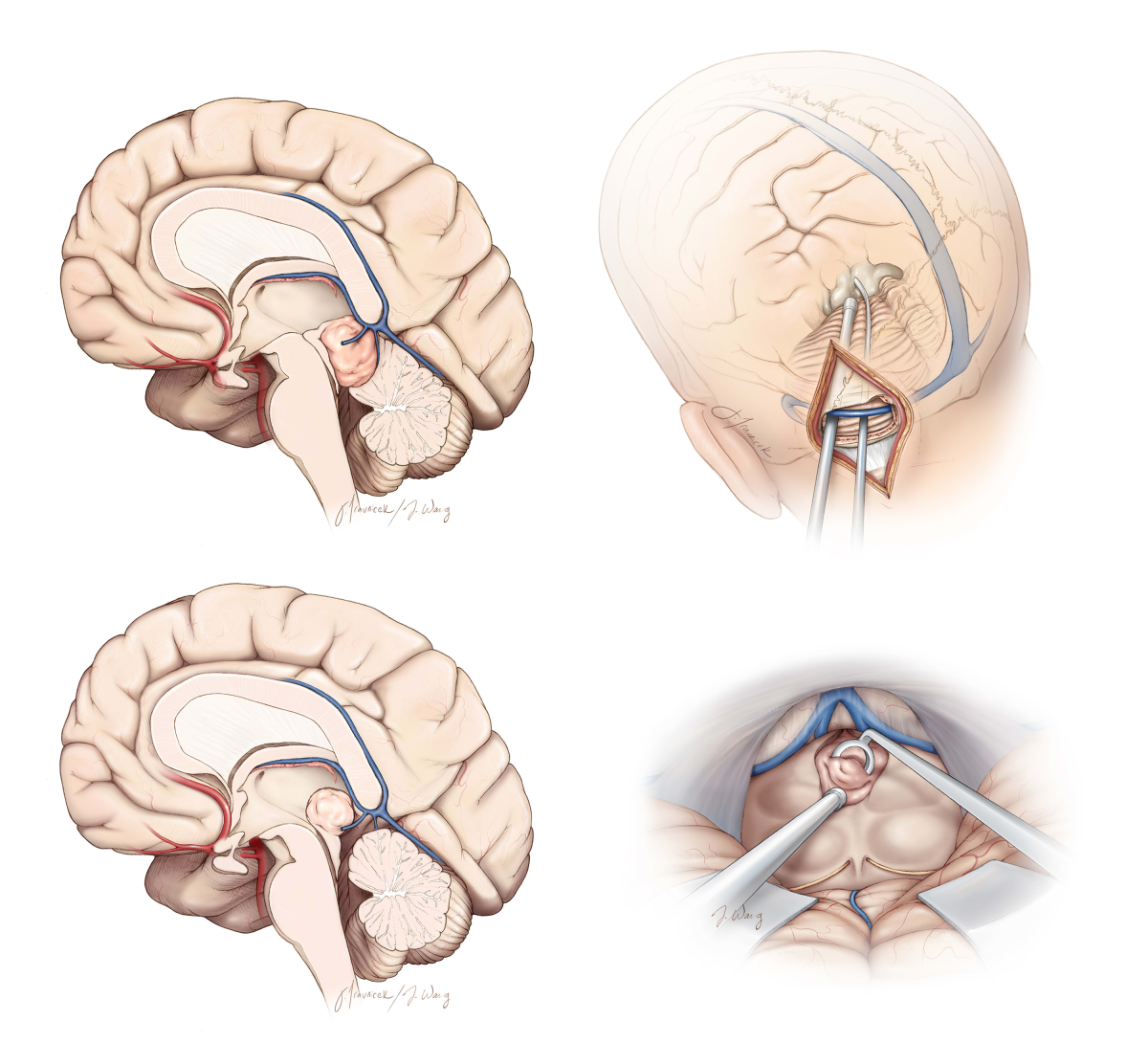 Midline Supracerebellar Craniotomy | Cohen Collection | Volumes | The ...