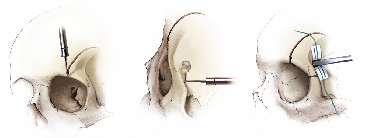 Orbitozygomatic Craniotomy | Cohen Collection | Volumes | The ...