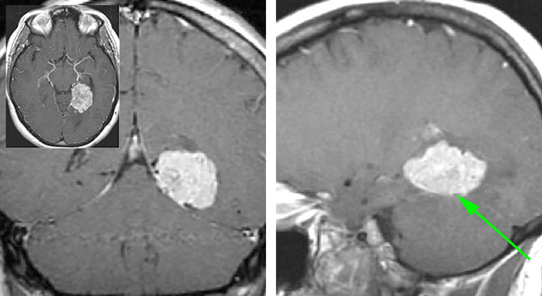 Tentorial Meningioma | Cohen Collection | Volumes | The Neurosurgical Atlas