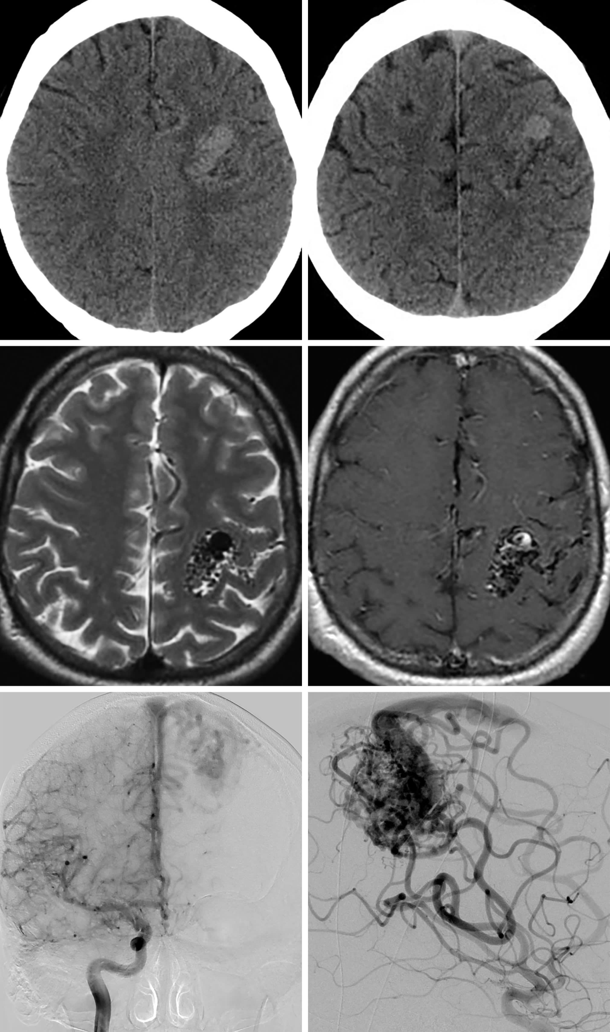 Arteriovenous Malformation | Cohen Collection | Volumes | The ...