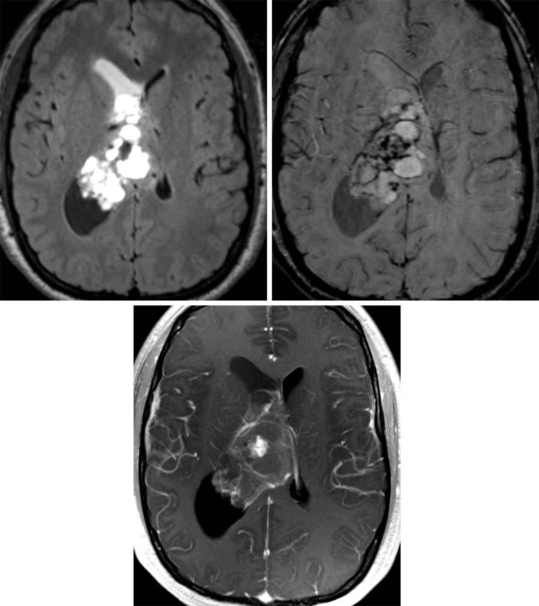 健康・医学 Micro-neurosurgical Atlas Microneurosurgical Atlas | SpringerLink