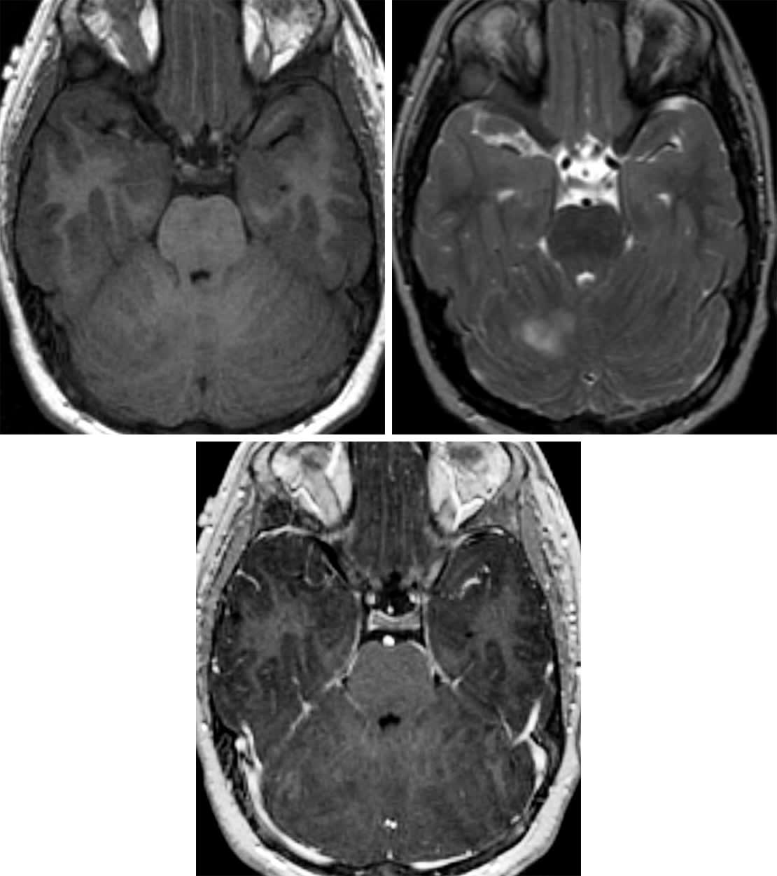 Dysplastic Cerebellar Gangliocytoma | Cohen Collection | Volumes | The ...