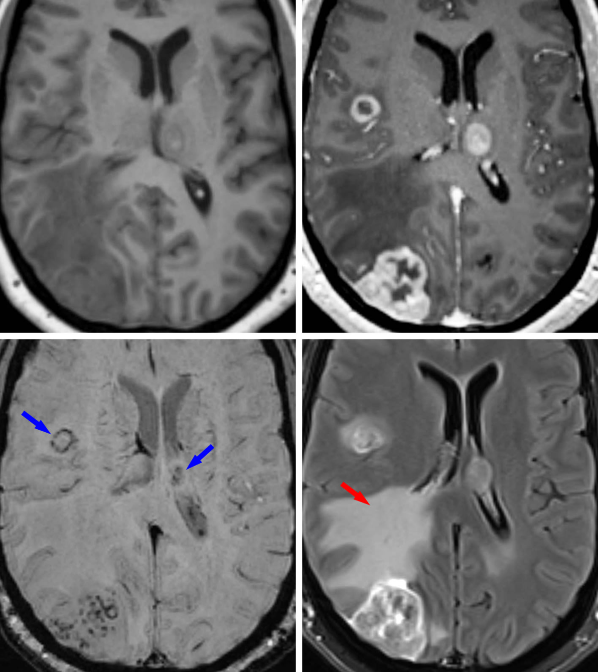 hemorrhagic or melanotic metastatic disease Malignant Nerve Sheath Tumor Metastasis | Cohen Collection |