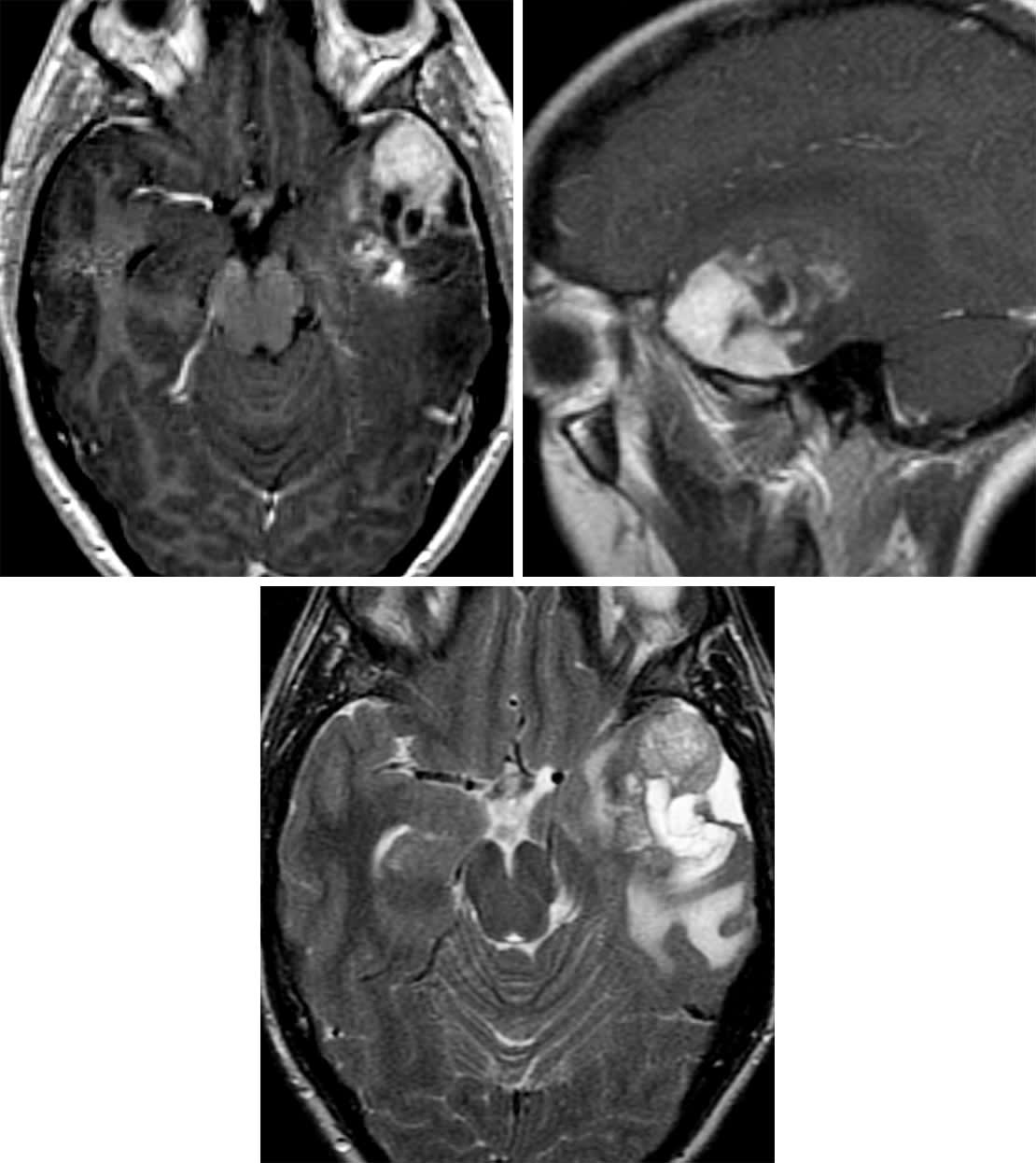 Pleomorphic Xanthoastrocytoma | Cohen Collection | Volumes | The ...