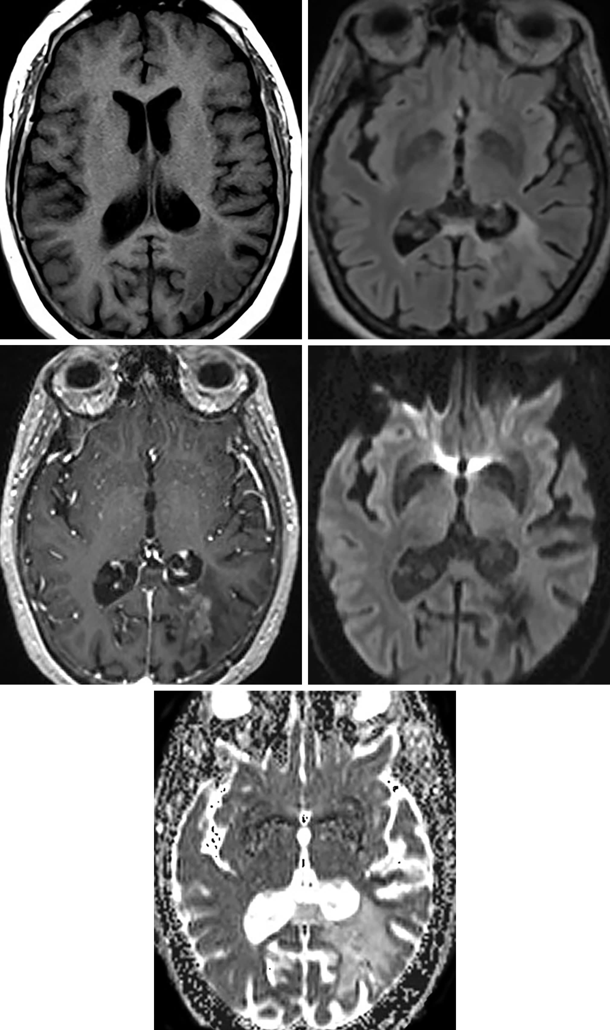 Cerebral Amyloid Angiopathy/Amyloidoma | Cohen Collection | Volumes ...