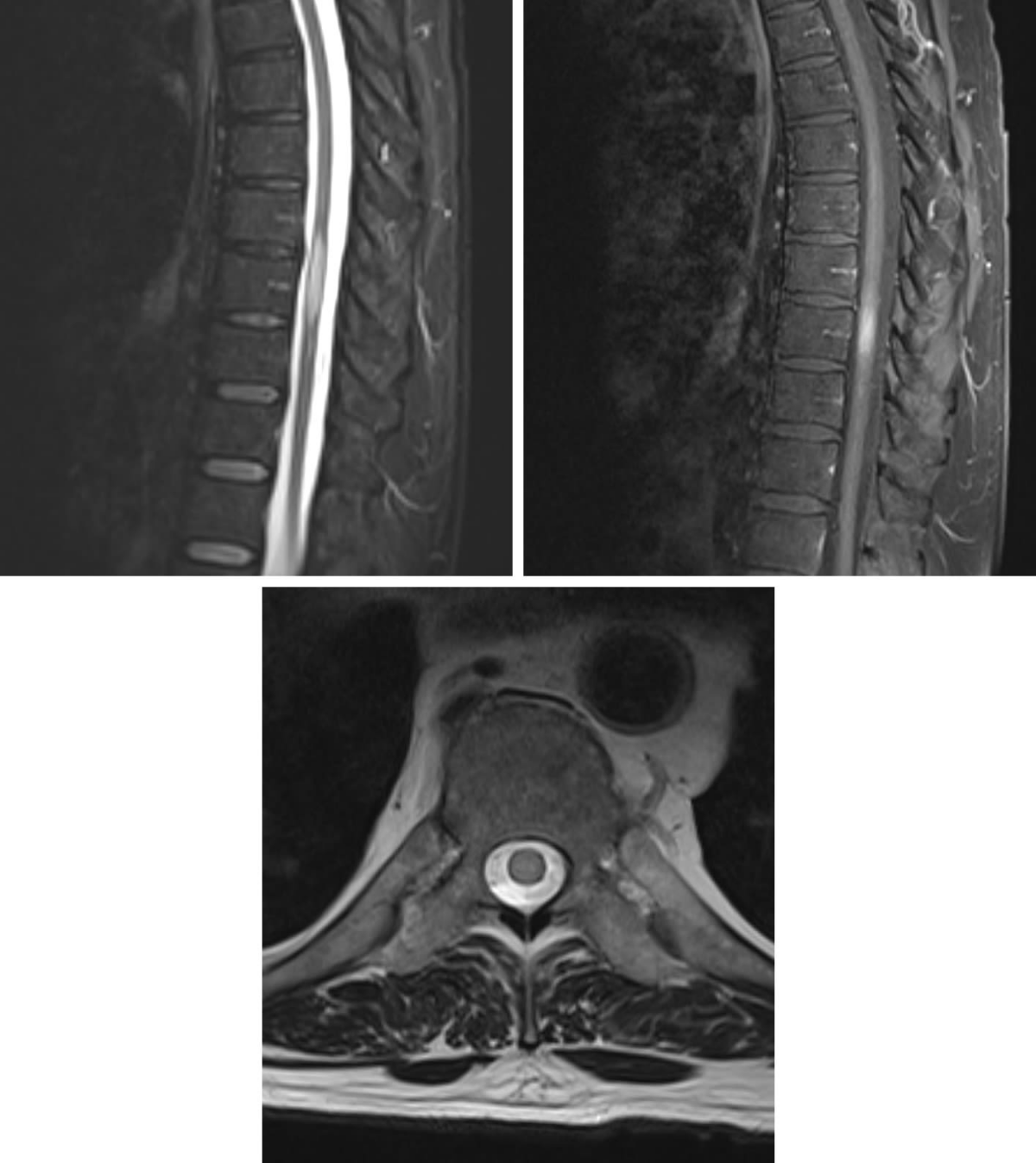 Acute Disseminated Encephalomyelitis (ADEM) | Cohen Collection ...