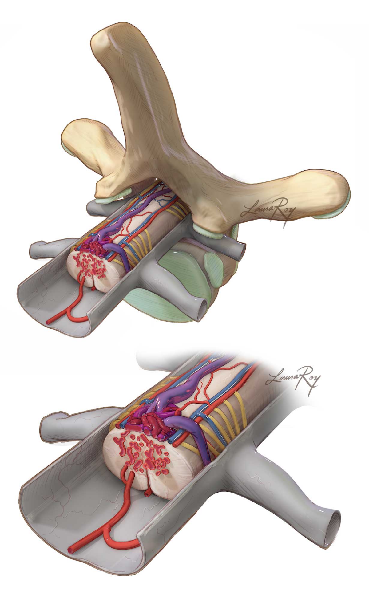 Spinal Cord AVM | Cohen Collection | Volumes | The Neurosurgical Atlas
